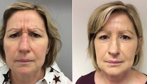 Before and After Wrinkle Treatment