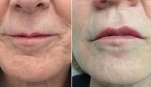 lip treatment buckinghamshire