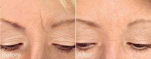 Before and After Wrinkle Treatment UK
