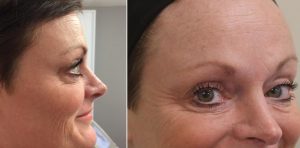 Before and After Wrinkle Treatment UK